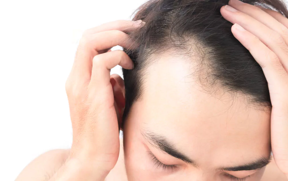 Receding Hairline: Stages, Causes, Prevention and Treatment Options 12