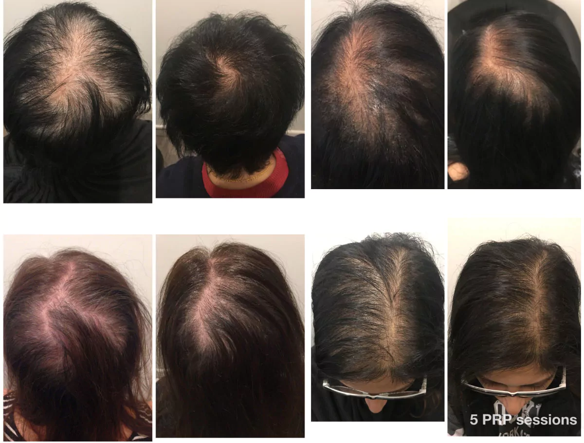 Female-PRP-Before-Afters