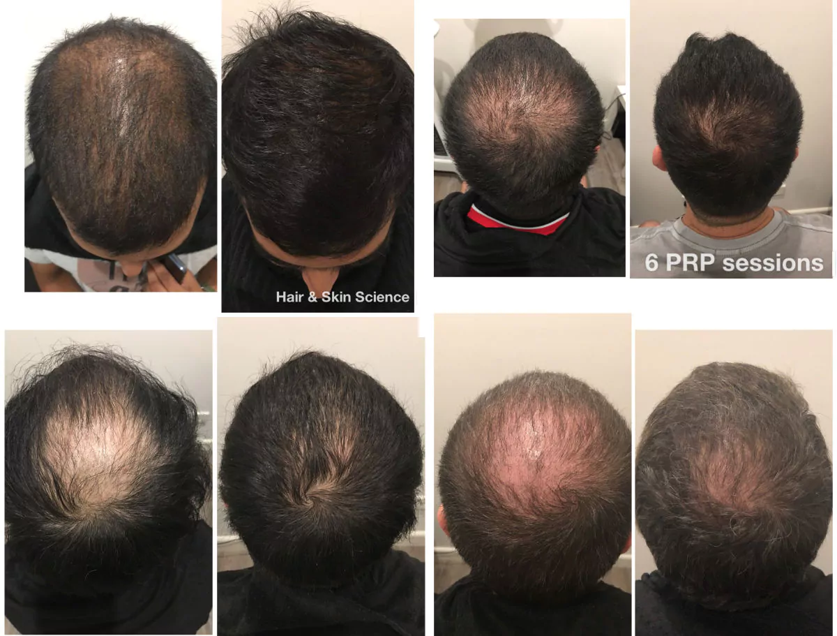 Male-PRP-Before-Afters