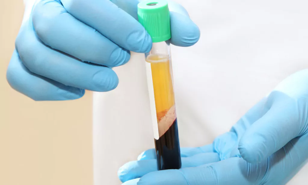 How much does PRP treatment cost in the UK? 5 How much does PRP treatment cost in the UK? 5