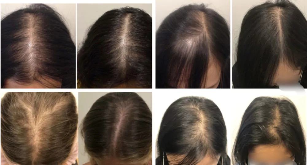 Female-PRP-Hair-Loss-Before-and-After-1