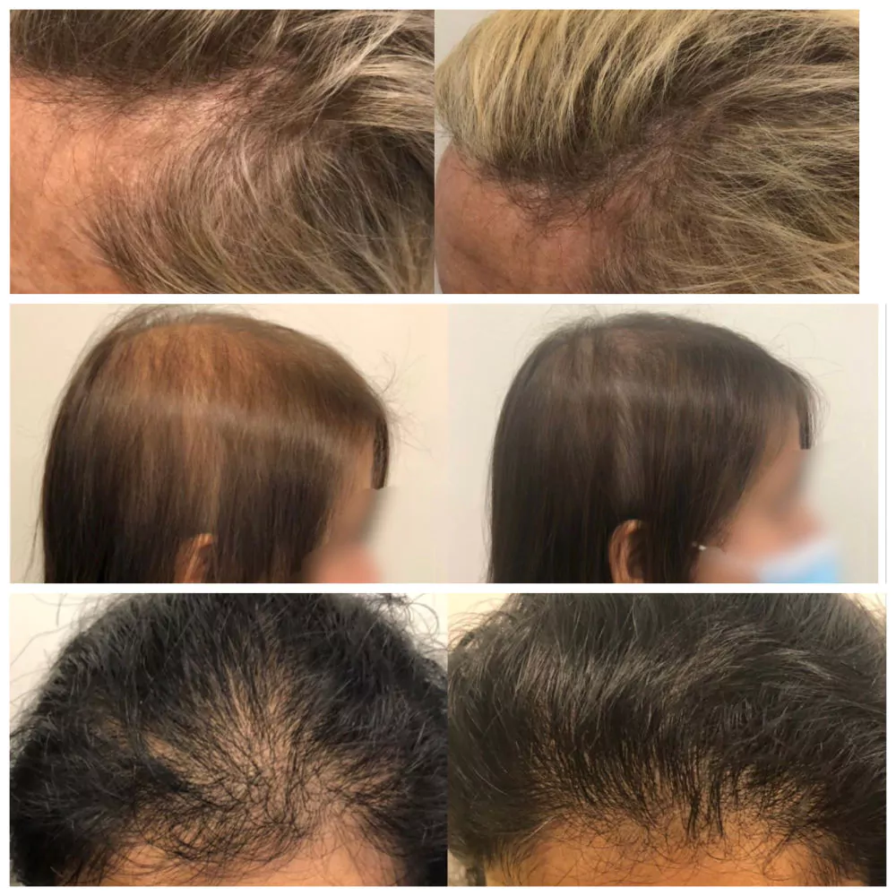 Female-PRP-Hair-Loss-Before-and-After-10