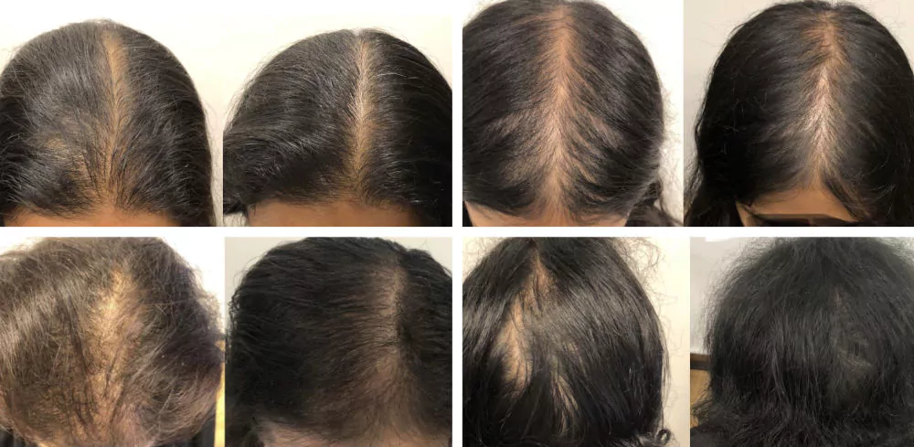 Female-PRP-Hair-Loss-Before-and-After-2