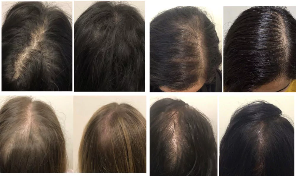 Female-PRP-Hair-Loss-Before-and-After-3
