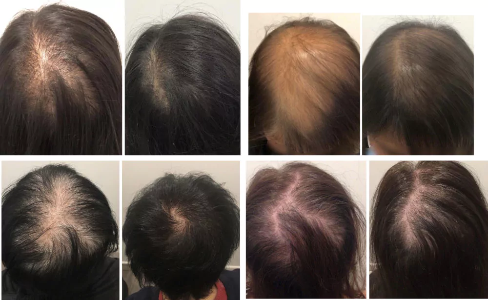 Female-PRP-Hair-Loss-Before-and-After-4