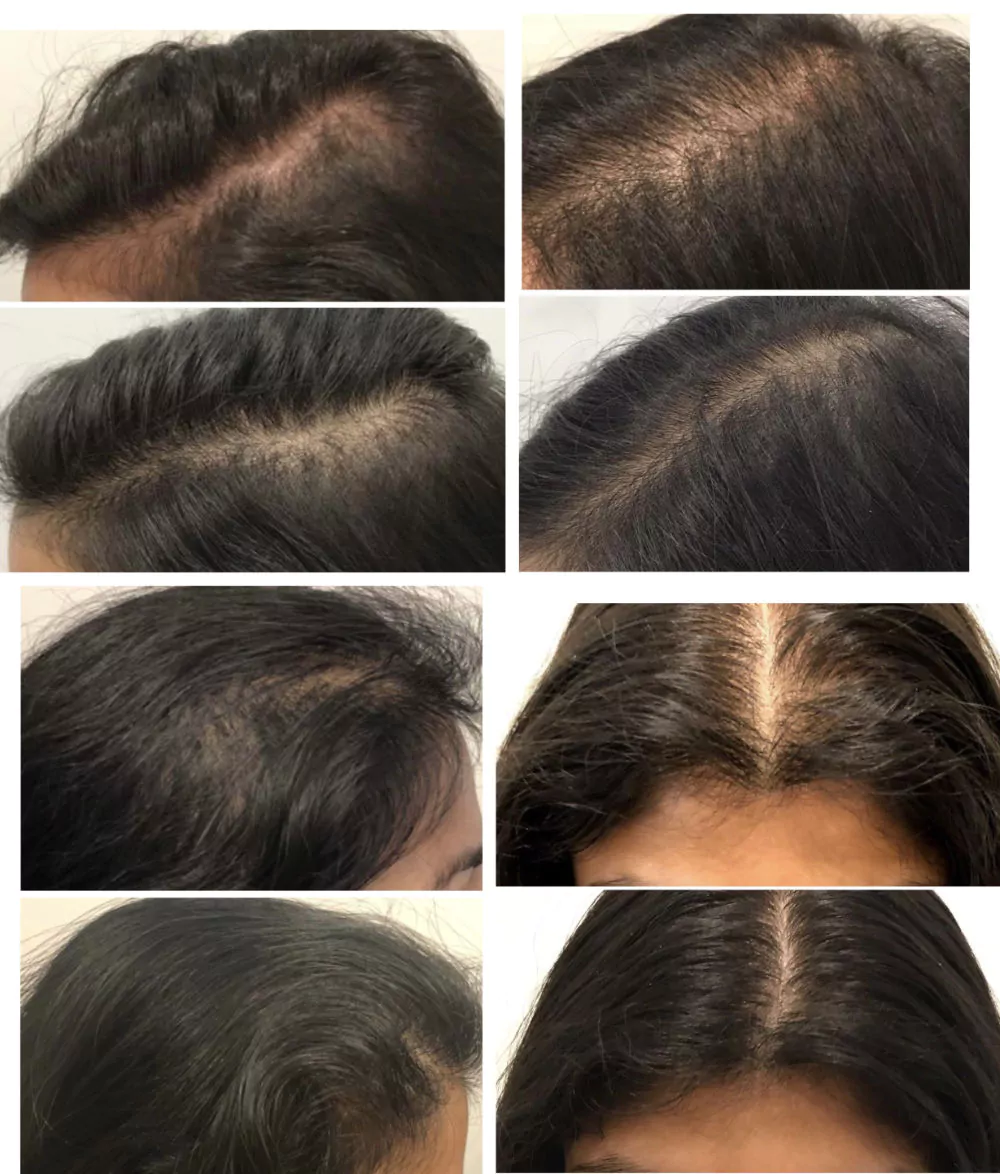 Female-PRP-Hair-Loss-Before-and-After-5
