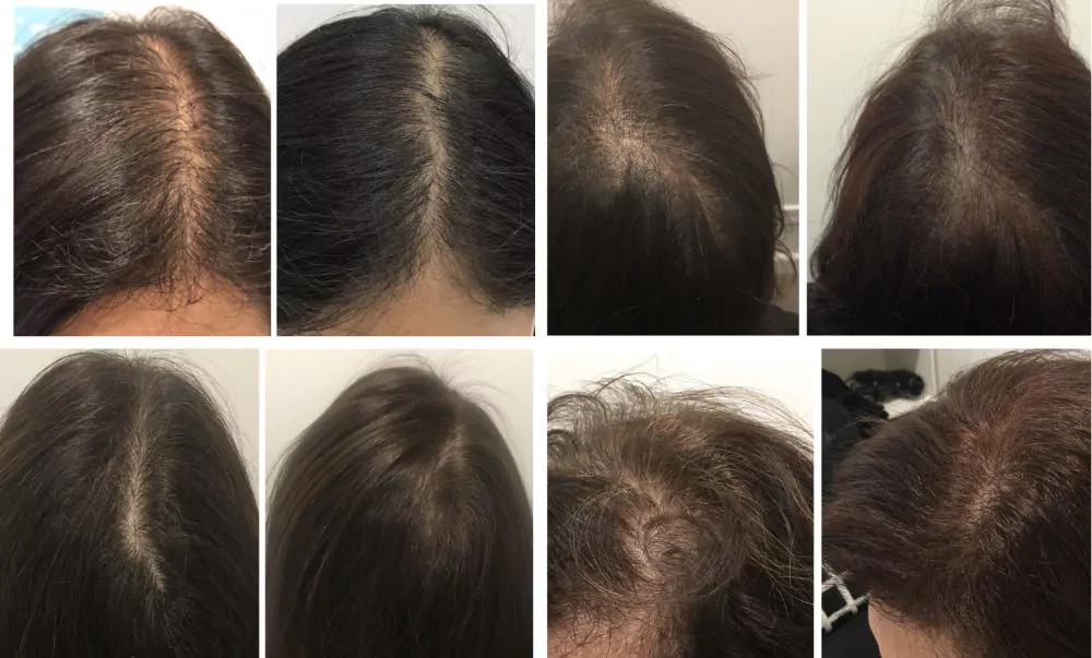 Female-PRP-Hair-Loss-Before-and-After-6