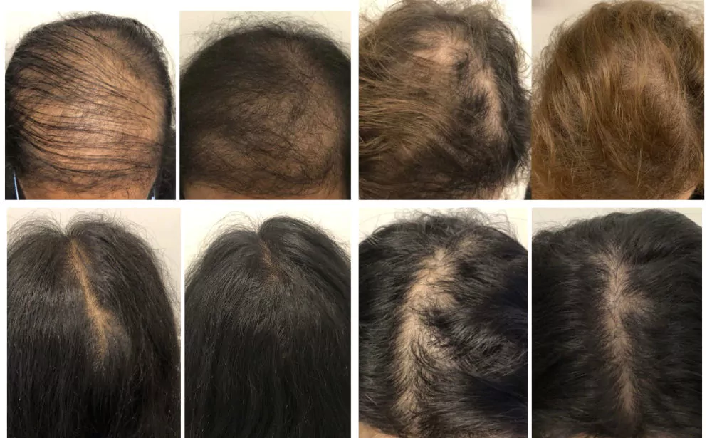 Female-PRP-Hair-Loss-Before-and-After-7