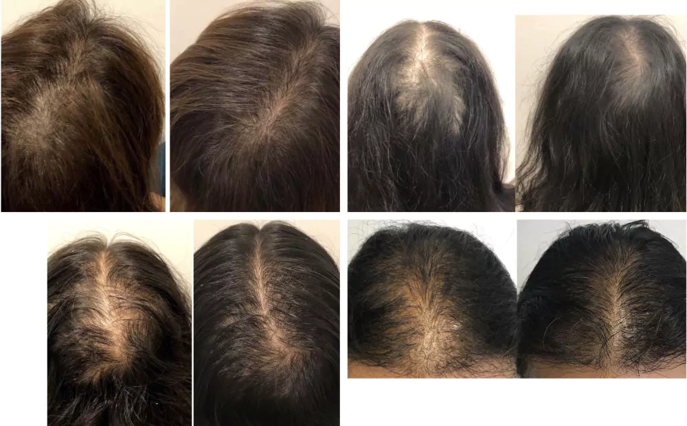 Female-PRP-Hair-Loss-Before-and-After-8