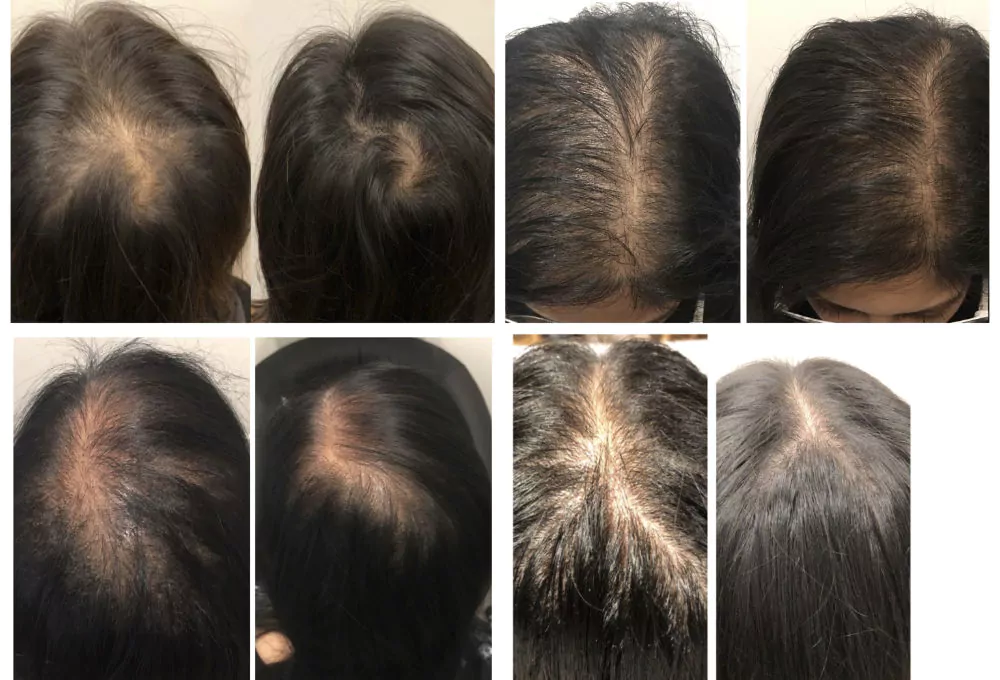 Female-PRP-Hair-Loss-Before-and-After-9
