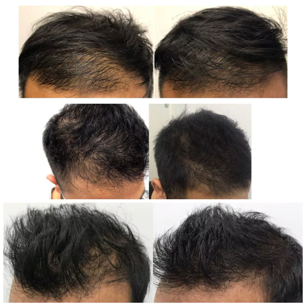 Male-PRP-Before-and-After-Photo-15