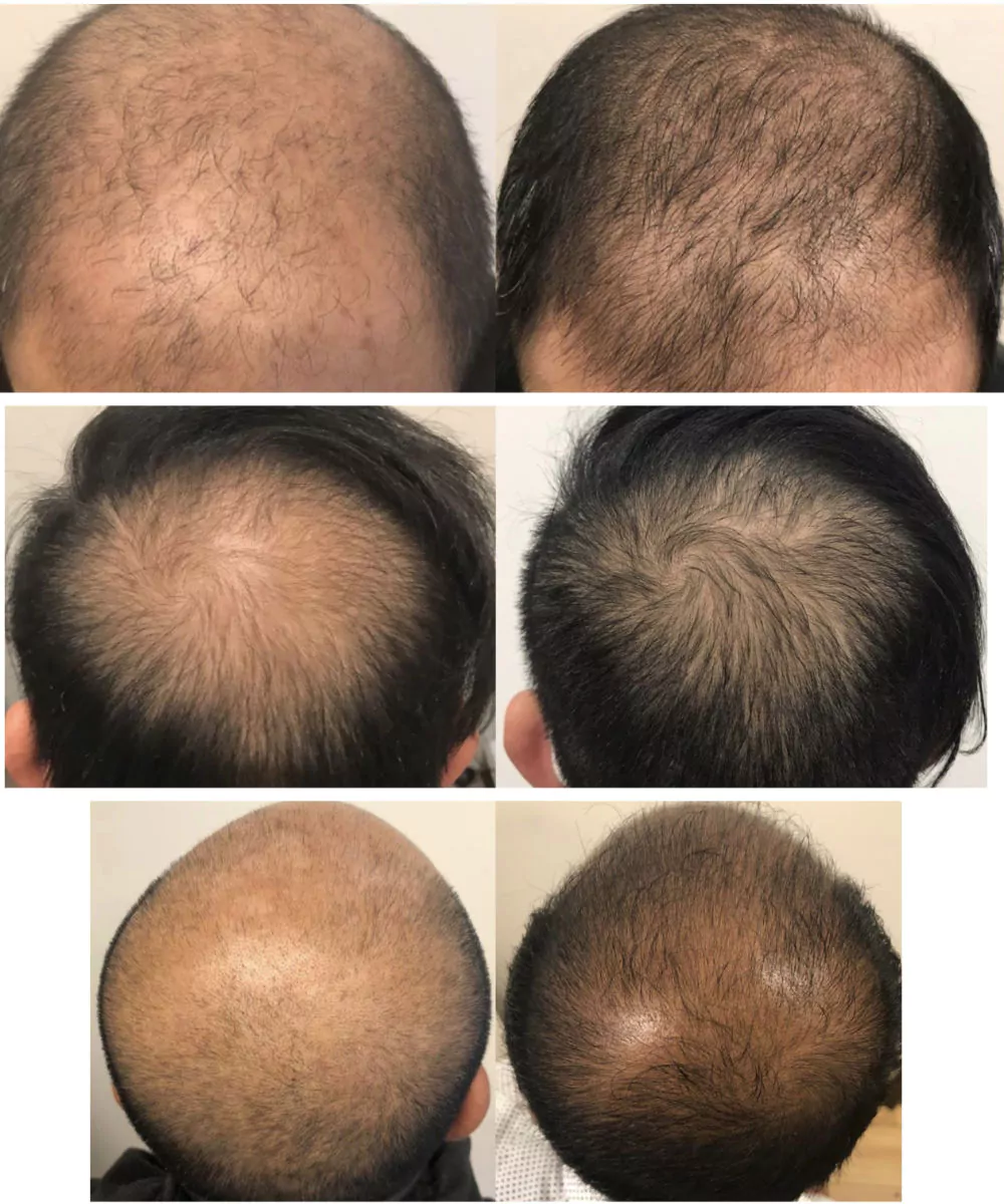 Male-PRP-Before-and-After-Photo-28