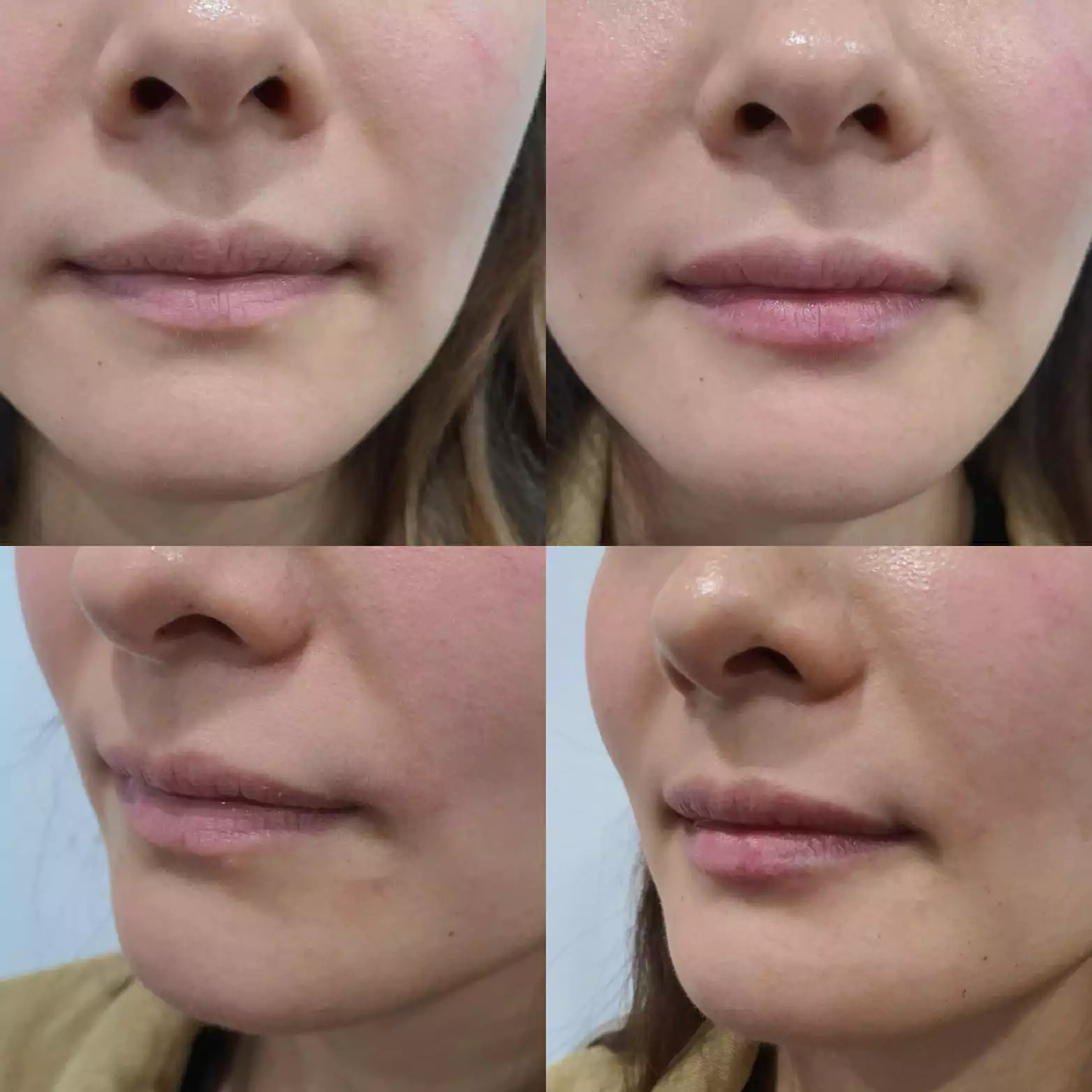 lip-filler2