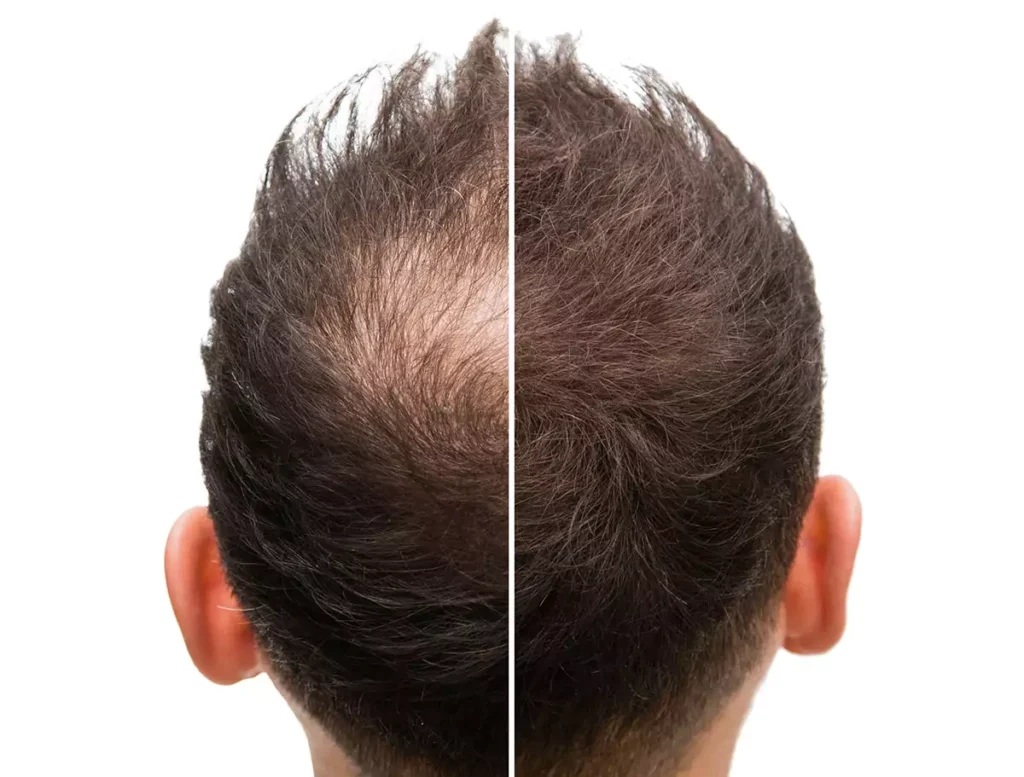 Revitalise Your Hair: The Ultimate Guide to PRP Hair Loss Treatment in London 2 Revitalise Your Hair: The Ultimate Guide to PRP Hair Loss Treatment in London 2